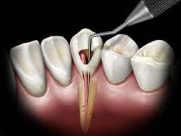 Relieve Your Dental Worries with Shree Patidar's Root Canal Expertise