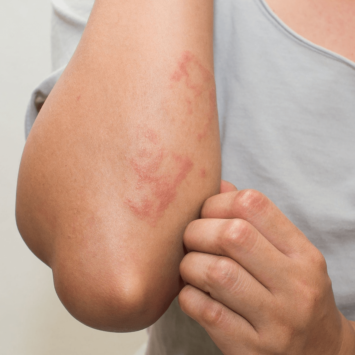 Embrace a Healthier Life: Overcoming Allergies with Homeopathy