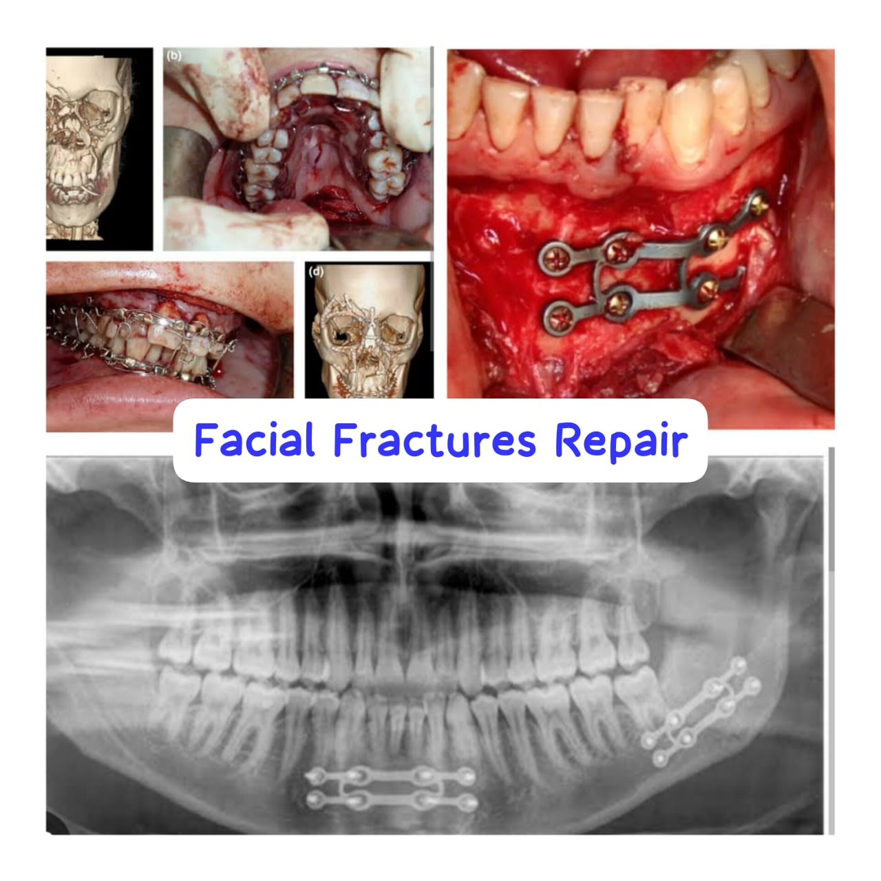 Healing with Care: Transforming Lives through Facial Fracture Solutions at Sun Dental