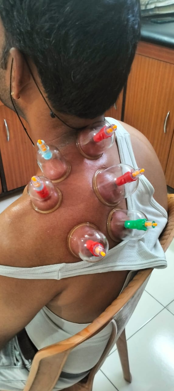 Rejuvenate Your Health with Cupping Therapy: A Journey to Pain-Free Living