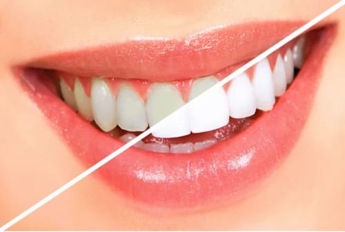 Transform Your Smile: The Magic of Teeth Whitening