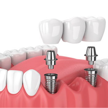 Transforming Smiles: How Rohan Found Confidence with Dental Implants