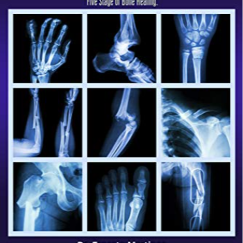 Healing Beyond the Fracture: Radhakrishna Hospital’s Journey with Ramesh