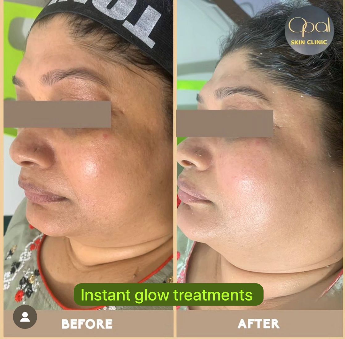 Illuminate Your Radiance: Kavita's Journey to Instant Glow