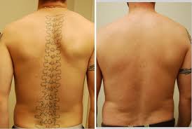Rediscover Your Skin: Safe and Effective Tattoo Removal for a Fresh Start