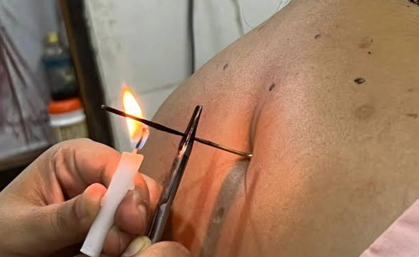 Discover the Healing Power of Agnikarma: A Traditional Remedy for Modern Ailments