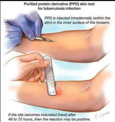 Transforming Health with the PPD Skin Test: A Journey with Sandhya Pathology Lab