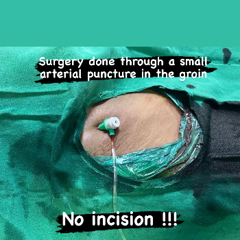 Transforming Lives: How Neurointervention Surgery Solved Anaya's Health Crisis