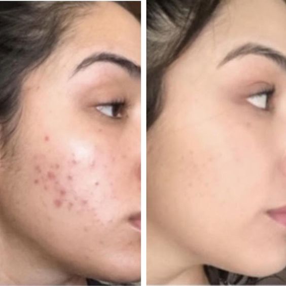 Embracing Confidence: How Pro Skin Acne Facials Transform Lives