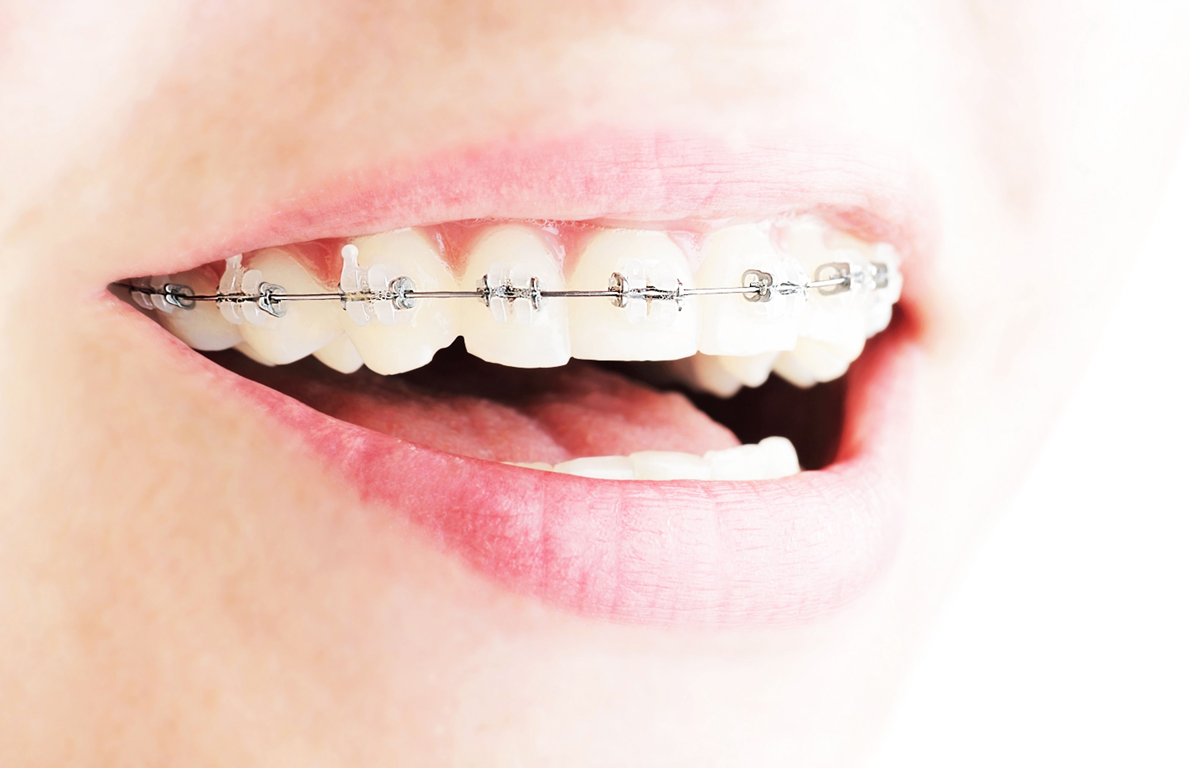 Transforming Smiles: The Journey of Dental Braces at Grace Dental Clinic