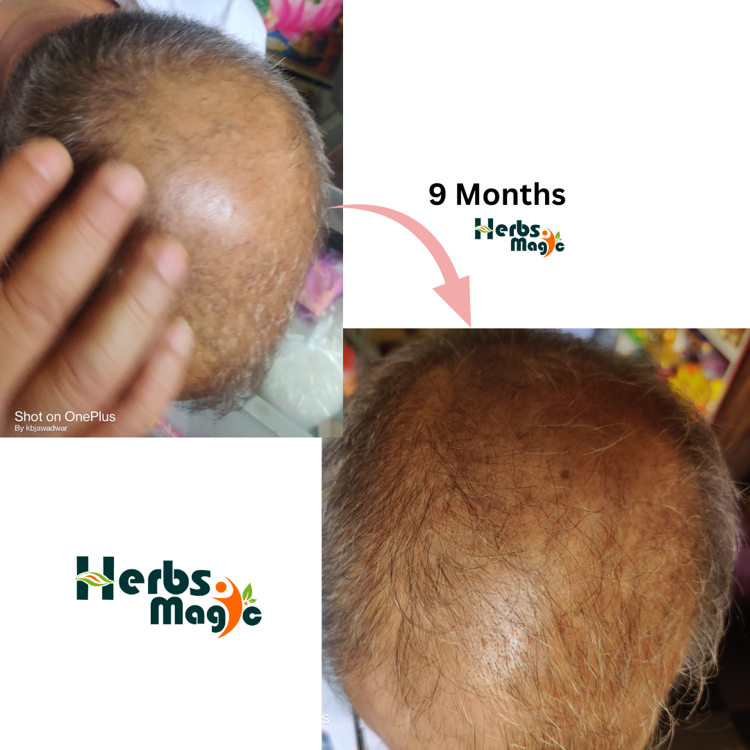 Transform Your Tresses: A Journey to Healthy Hair with Herbal Consultation