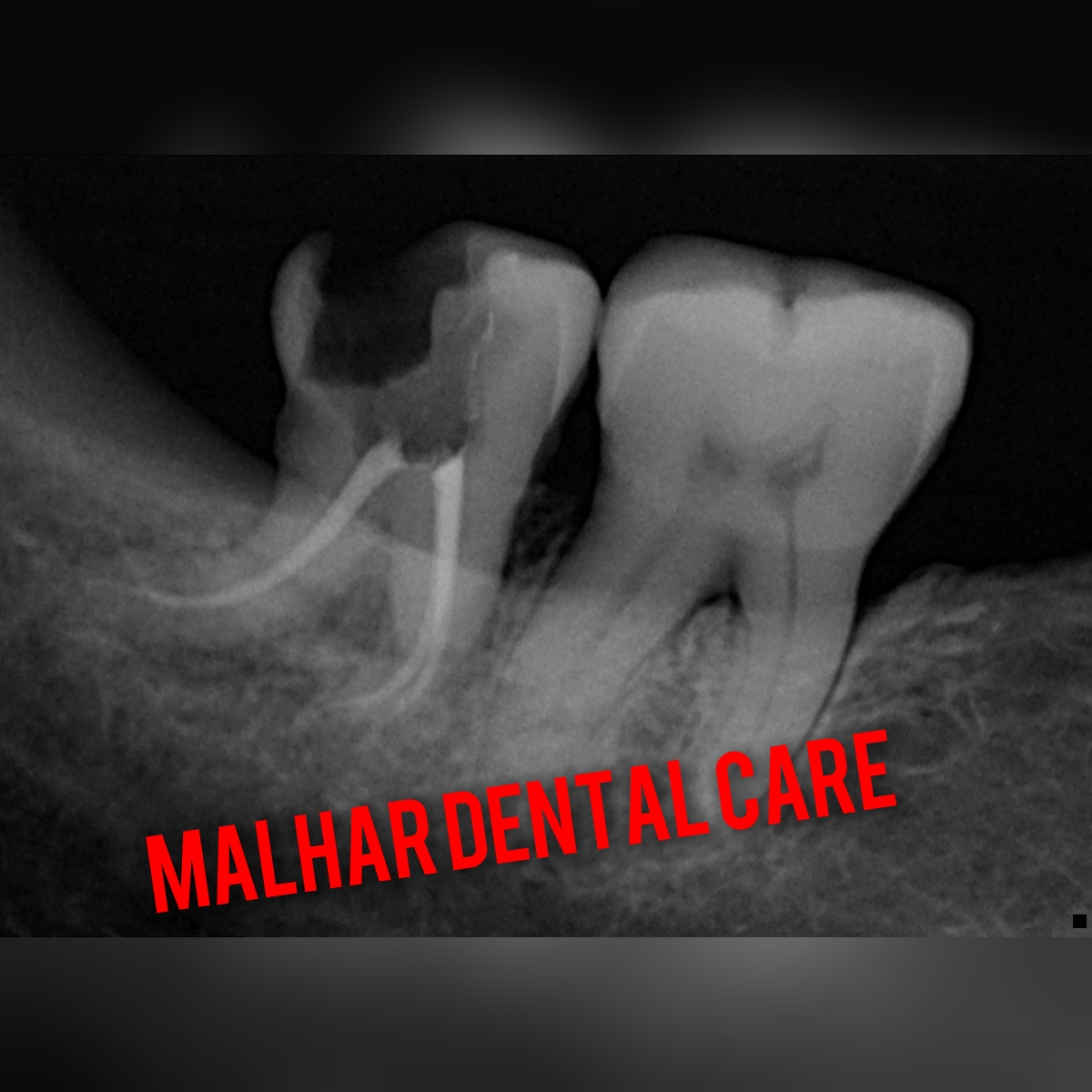 Transforming Smiles: The Story of Aarti and Her Journey to Pain-Free Living