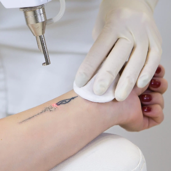 Embrace a Fresh Start: The Healing Power of Laser Tattoo Removal