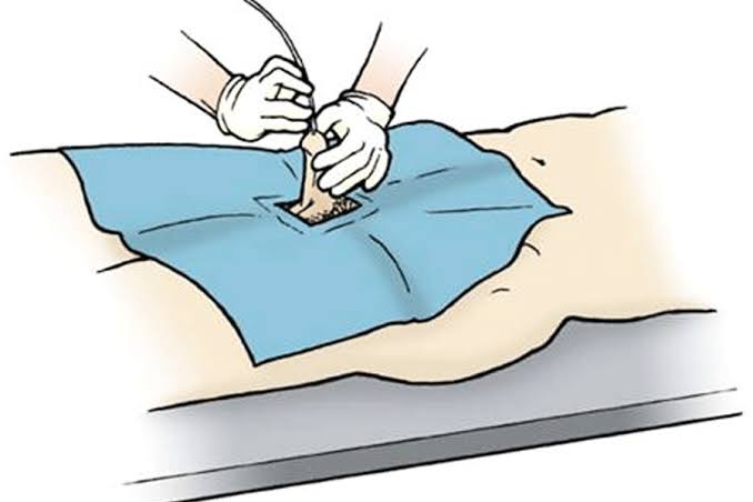 Unveiling the Power of Uttar Basti: A Journey Towards Holistic Healing