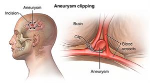 A New Dawn: Finding Hope with Cerebral Aneurysm Clipping