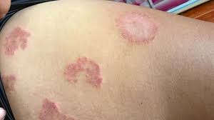 Healing Beyond the Surface: Transforming Lives with Homeopathy for Skin Disorders