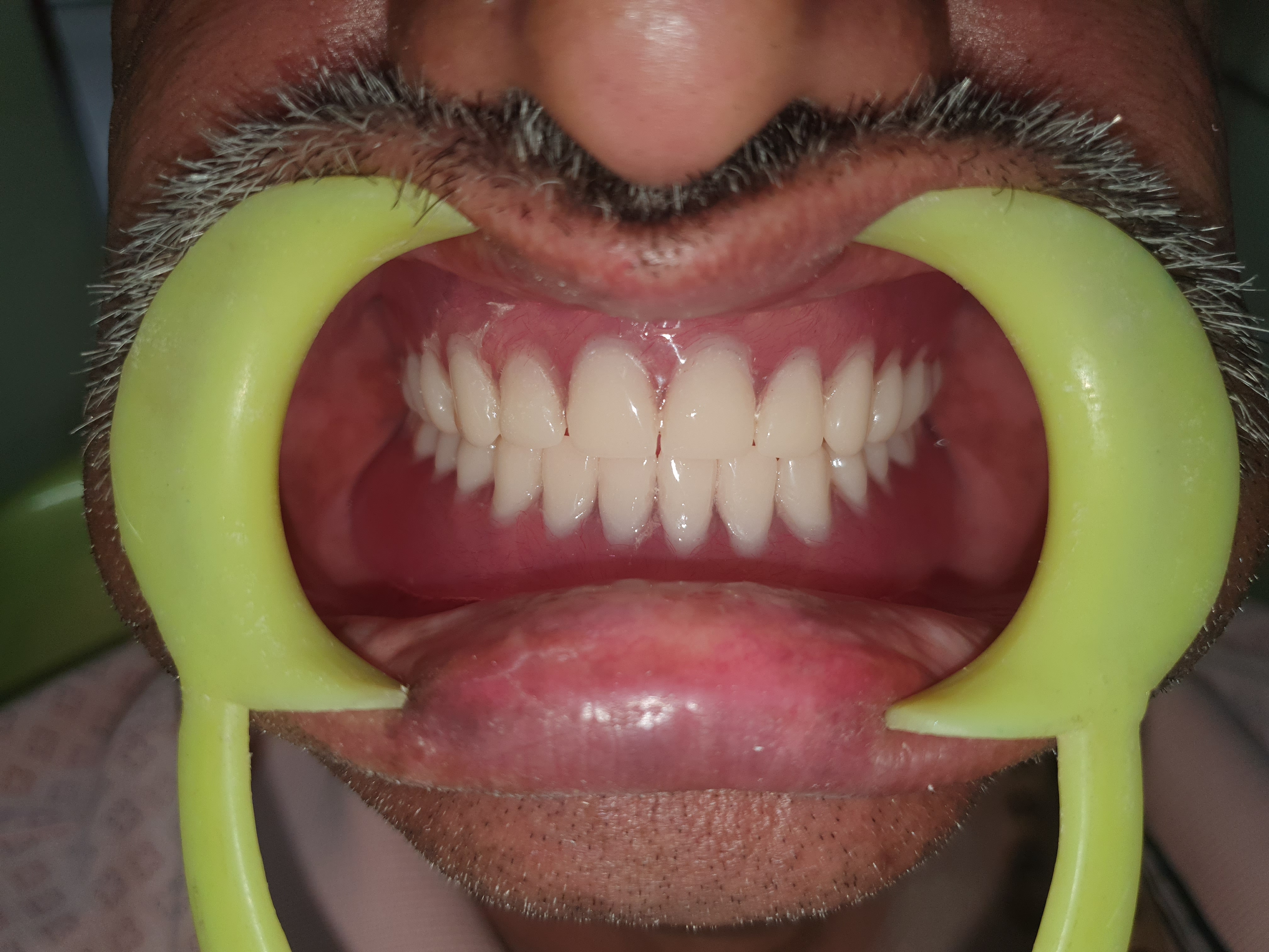 Transforming Smiles: How Denture Services Reignite Confidence at Malhar Dental Clinic