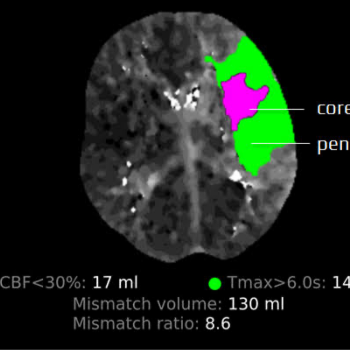A Ray of Hope: Overcoming Stroke with Comprehensive Care