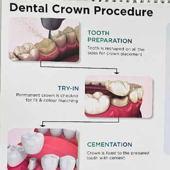 How Dental Crowns Transformed Priya's Smile and Confidence