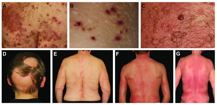 Healing Beyond the Surface: Transforming Lives with Homeopathy for Skin Diseases