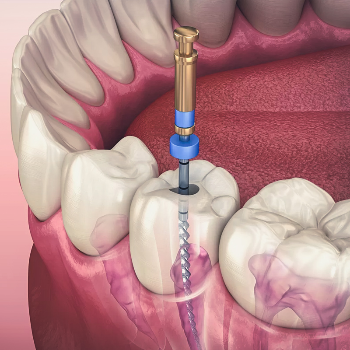 Healing Smiles: How Root Canal Treatment Transformed Radhika's Life