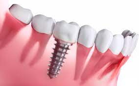 Transforming Smiles: The Life-Changing Impact of Dental Implants