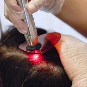 Rekindling Confidence: How Laser Hair Regrowth Treatment Transformed Meena’s Life