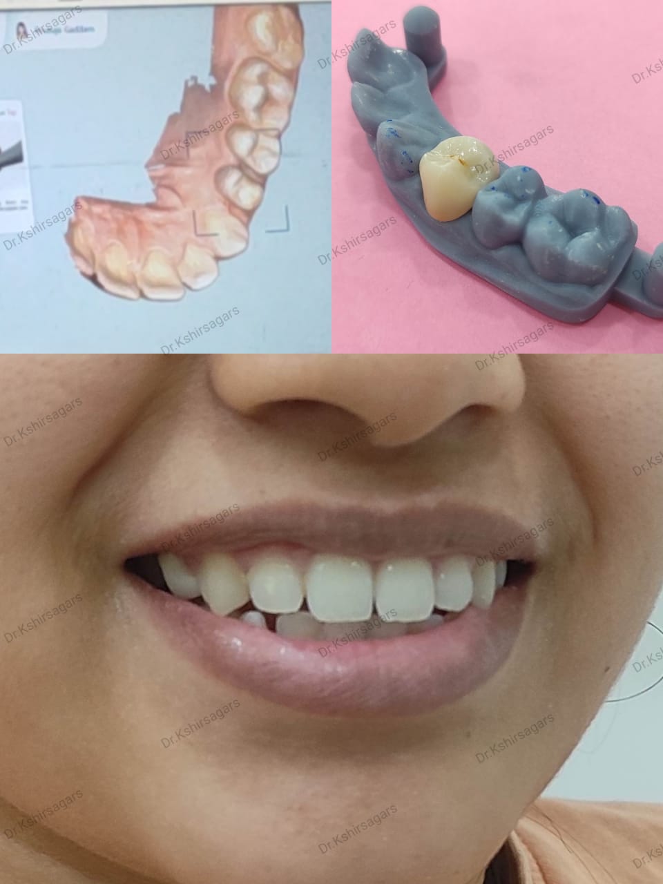 Embracing Confidence with Zirconia Full Ceramic Caps: A Smile Transformation Journey