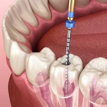 Transforming Pain into Relief: The Story of Root Canal Treatment at Yashashree Dental Family Care