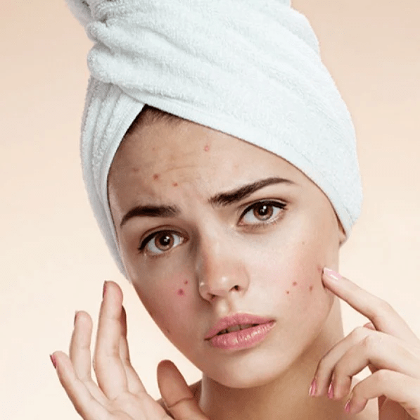 Embrace Clear Skin: Rashmi’s Journey to Overcoming Acne with Homeopathy