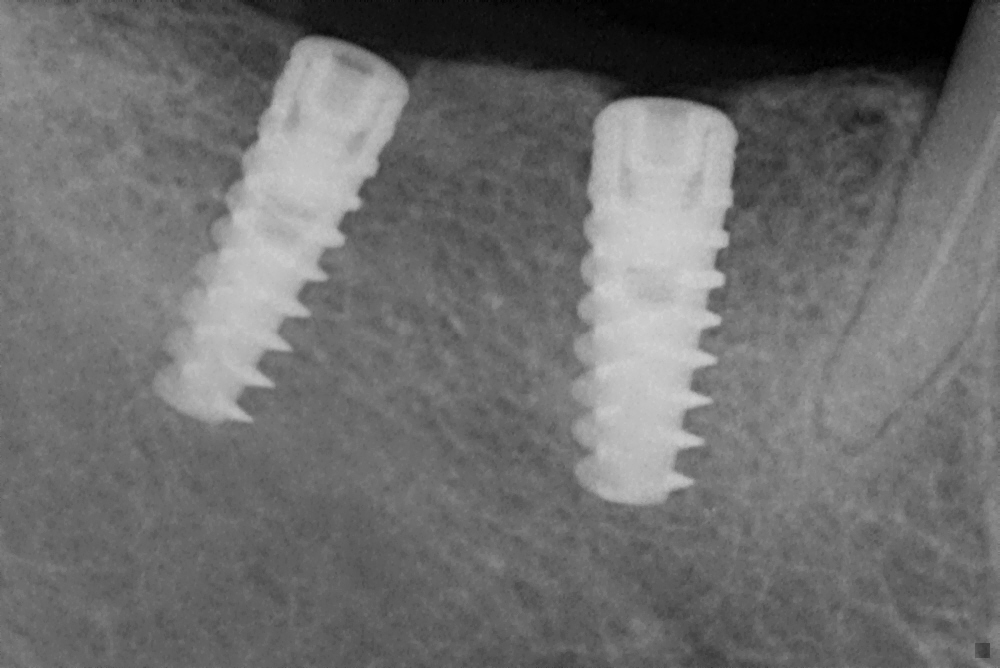 Transform Your Smile: How Dental Implants at Malhar Dental Clinic Changed Rohan's Life