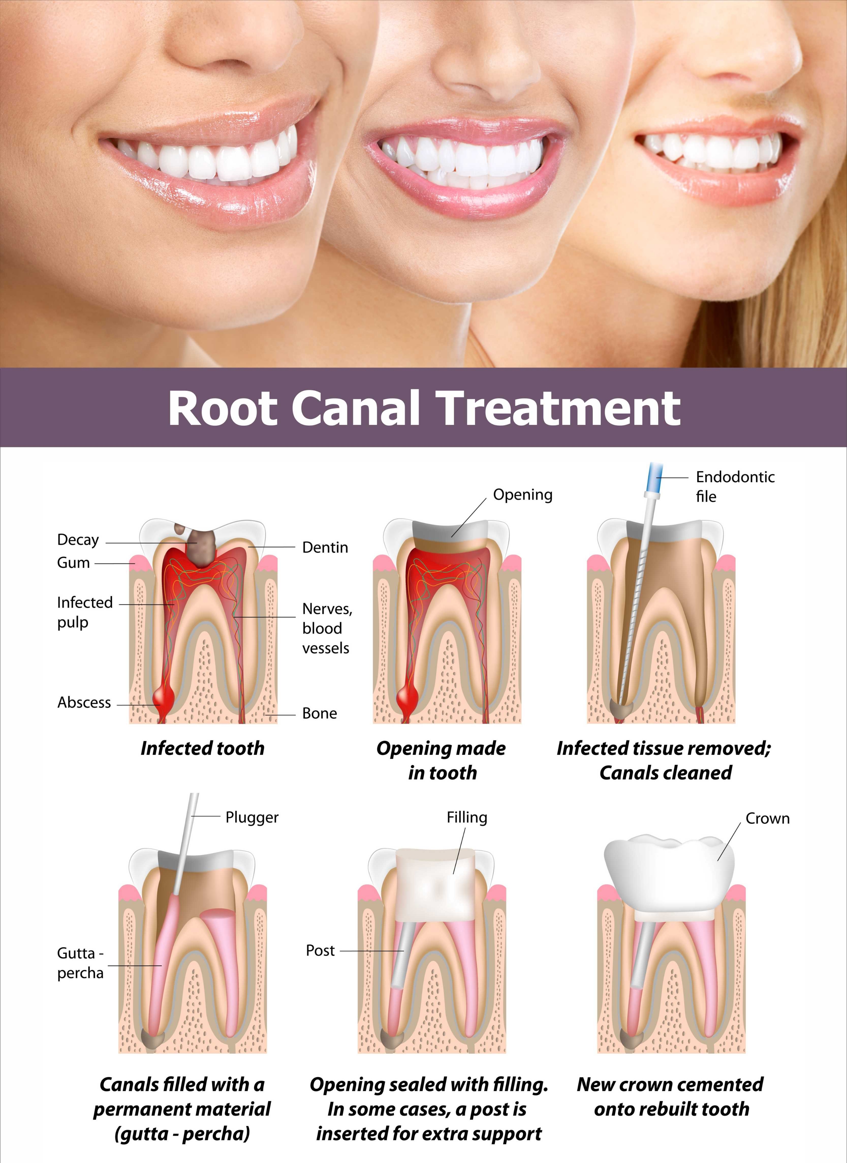 Transform Your Smile: How Root Canal Treatment Changed Anita's Life