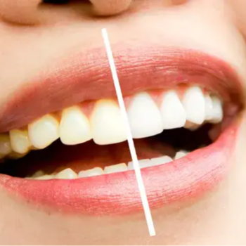 Transforming Smiles: The Journey of Meera and the Impact of Cosmetic Tooth Surgeries