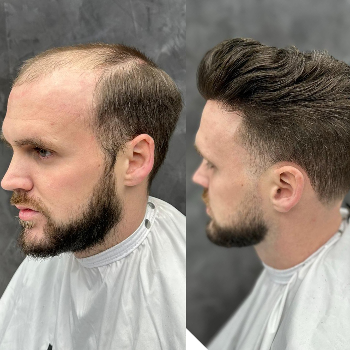 Rediscover Confidence: Hair Systems Transform Lives at Dream's Hair Replacement Center