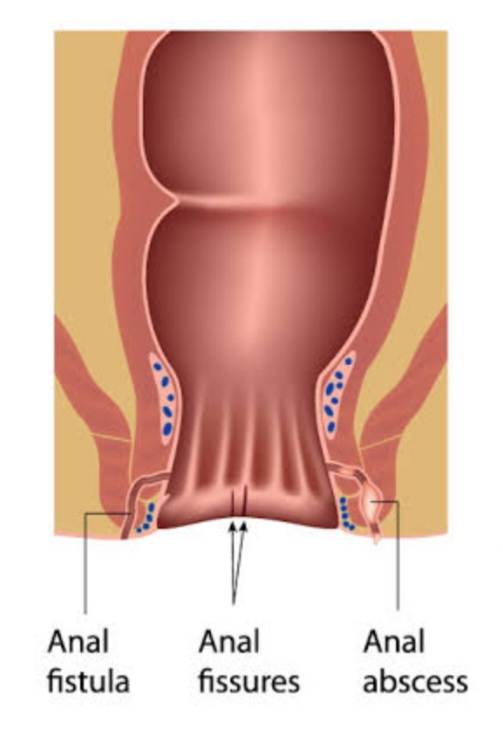 Finding Relief: How Anal Fissure and Fistula Treatment Transformed Ravi's Life