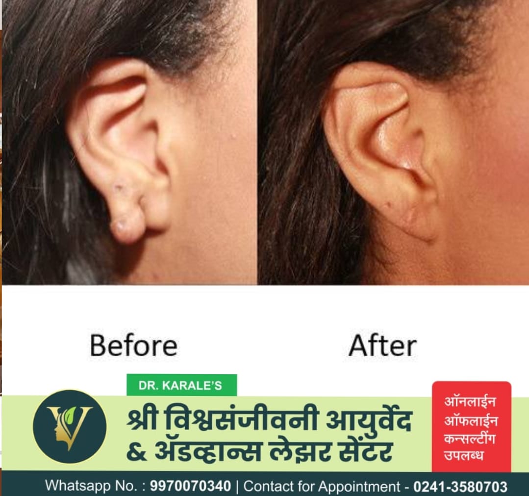 Overcoming Keloid Challenges: A Journey to Renewed Confidence