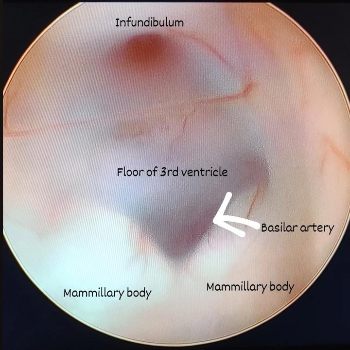 Embracing a New Life: How Minimal Invasive Brain and Spine Surgery Transforms Lives