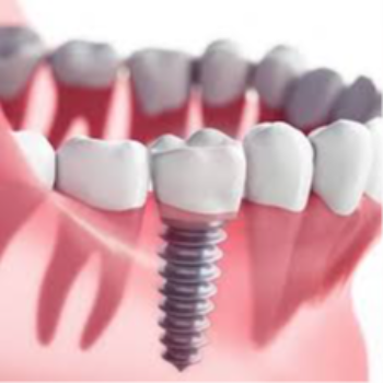 Transforming Smiles and Lives with Dental Implants: Meet Rakesh's Journey