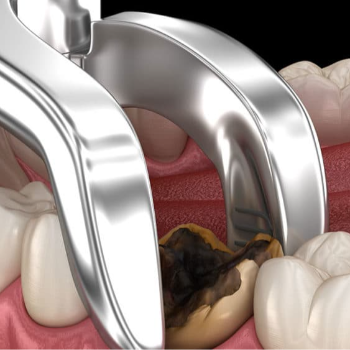 A New Smile Awaits: How Dental Extractions Transformed Raj's Life