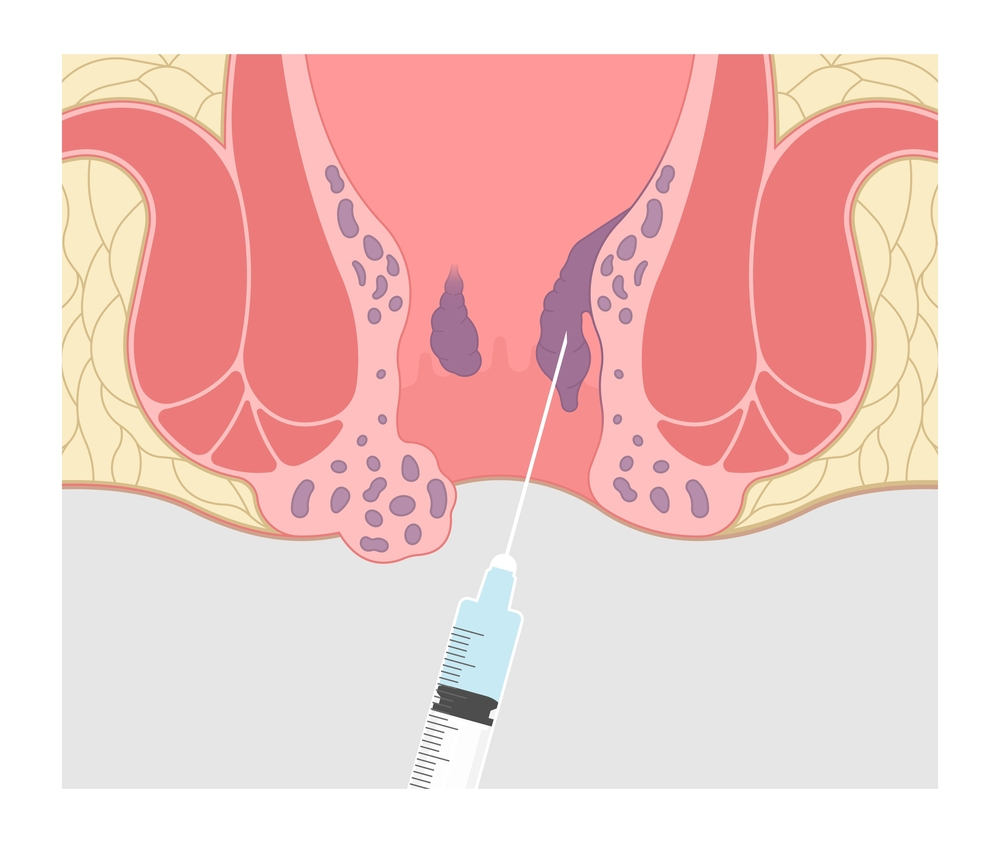 Finding Relief: How Injection Therapy Transformed Meera’s Life
