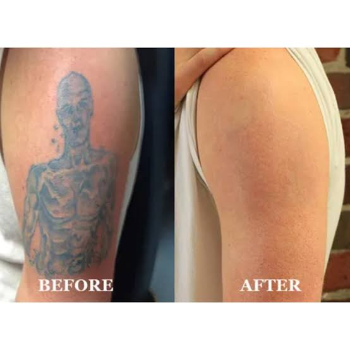 Transforming Stories: How Tattoo Removal Changed Riya's Life