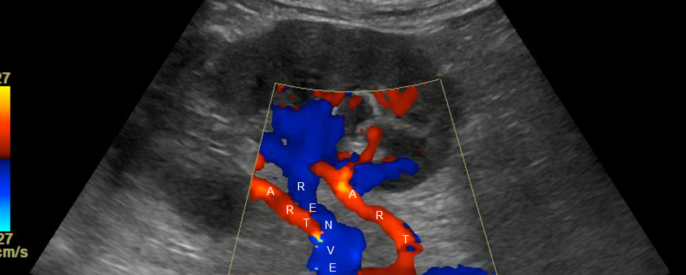 Unveiling the Power of Renal Artery Color Doppler: A Lifeline for Your Health