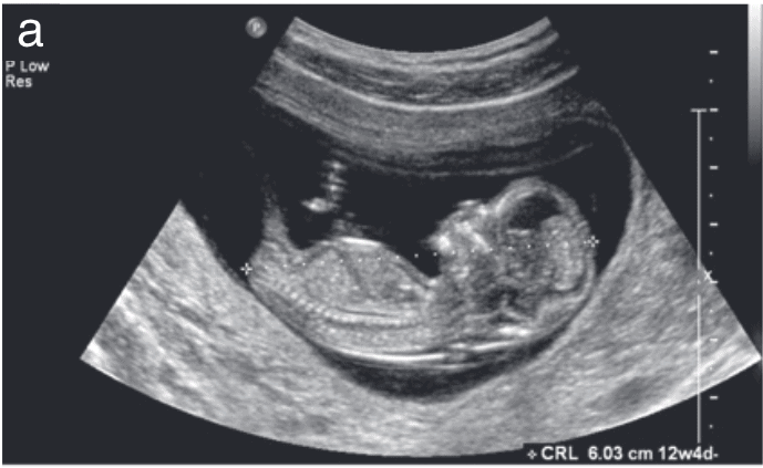 Embracing Motherhood with Confidence: The Transformative Power of Obstetric Ultrasonography