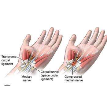 Finding Relief: A Journey Through Carpal Tunnel Syndrome