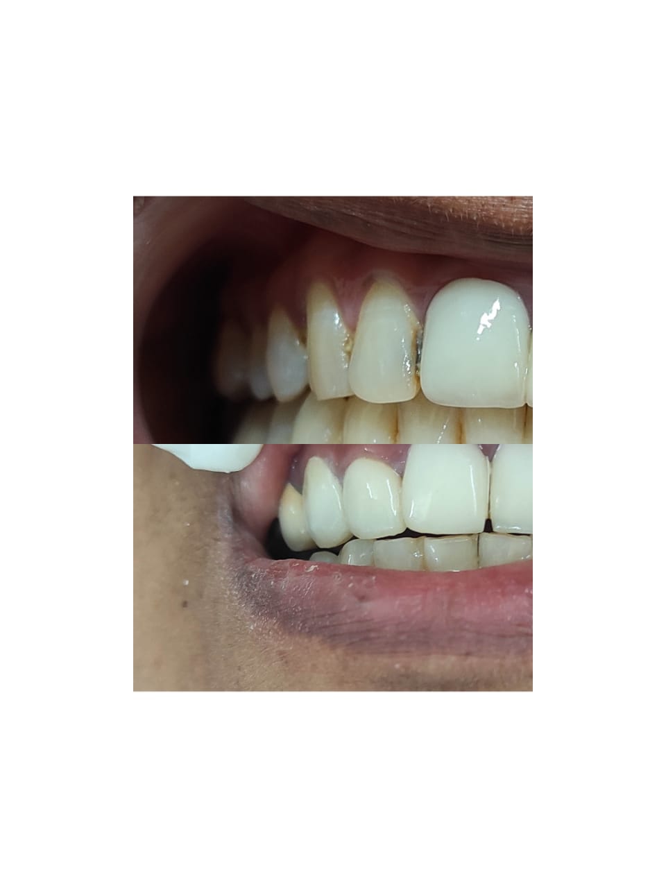 Smiling with Confidence: How Zirconia Caps Transform Lives