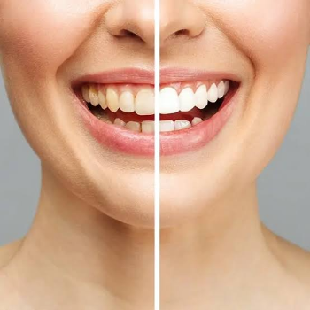 Transforming Smiles: How Teeth Cleaning and Polishing Changed Riya's Life