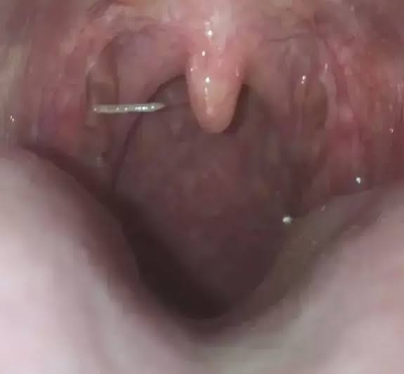 When Dinner Bites Back: A Fish Bone Removal Journey at Dr. Surya's ENT Care Centre