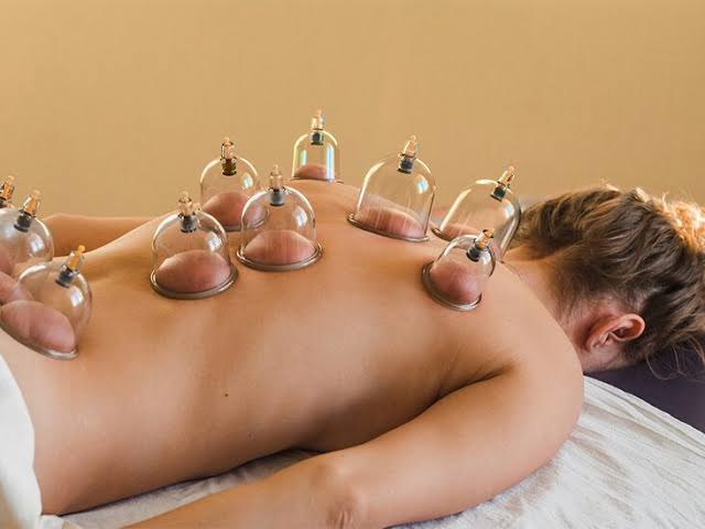 Embrace Healing: Cupping Therapy’s Ancient Remedy for Modern Stress