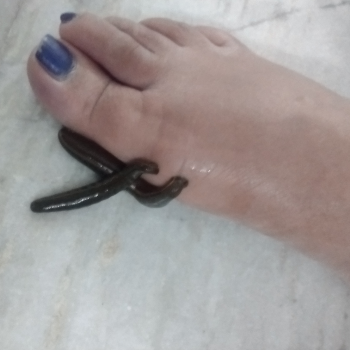 Rediscovering Health: How Leech Therapy Transformed Meena’s Life