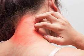 Relief from Khujli: Rekha's Journey to Comfort with Ayurvedic Solutions